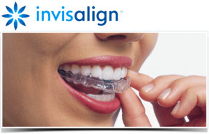 invisalign aligners